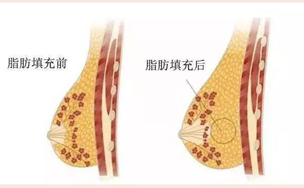 假体隆胸与自体脂肪的区别