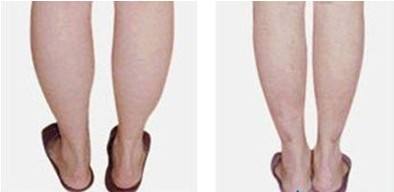 小腿吸脂减肥的特点和护理