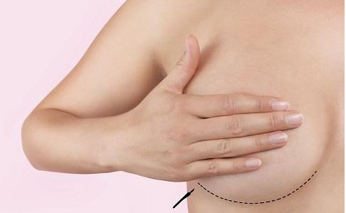 自体脂肪隆胸后运动减肥会导致乳房缩水吗